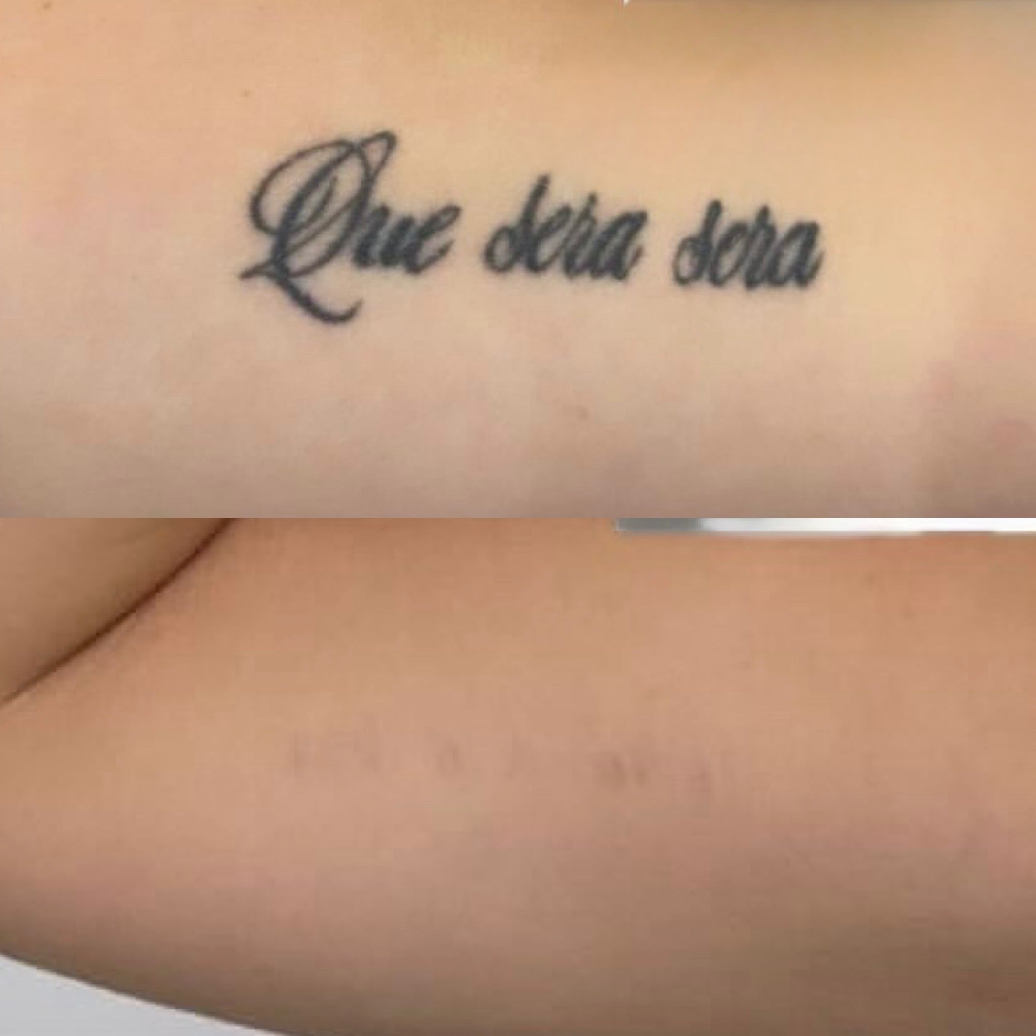 Pico Laser Tattoo Removal